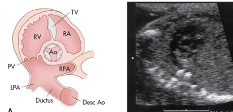 Fetal programming and cardiovascular pathology .